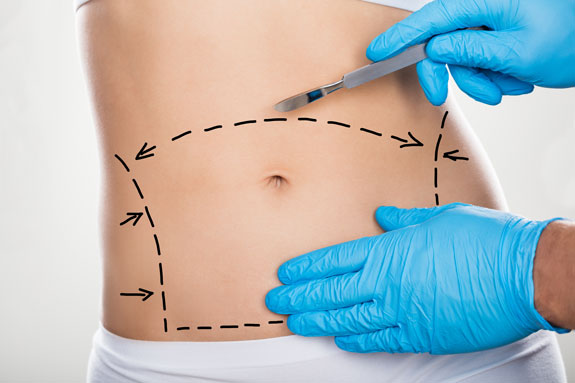 Abdominoplastik Stade